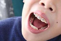 【健康解碼】矯正牙齒真的可以瘦臉嗎？